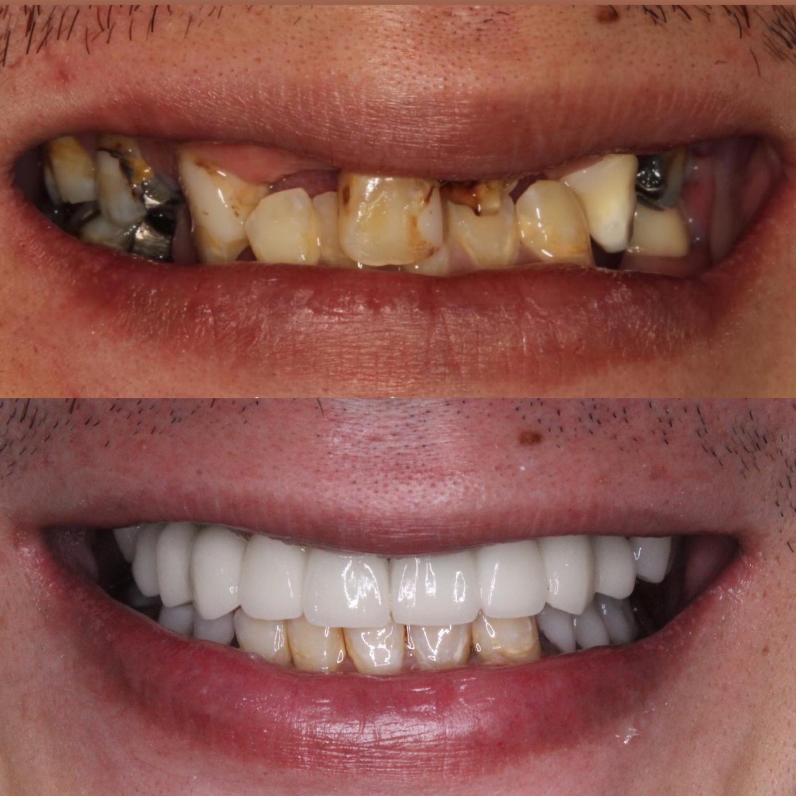 Full Mouth Rehabilitation With Dental Implants