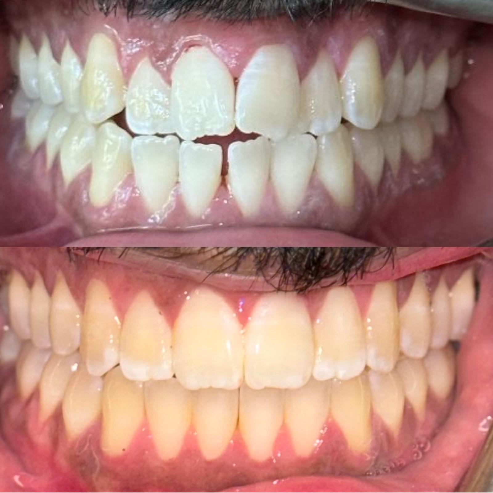 Invisalign before and after treatment