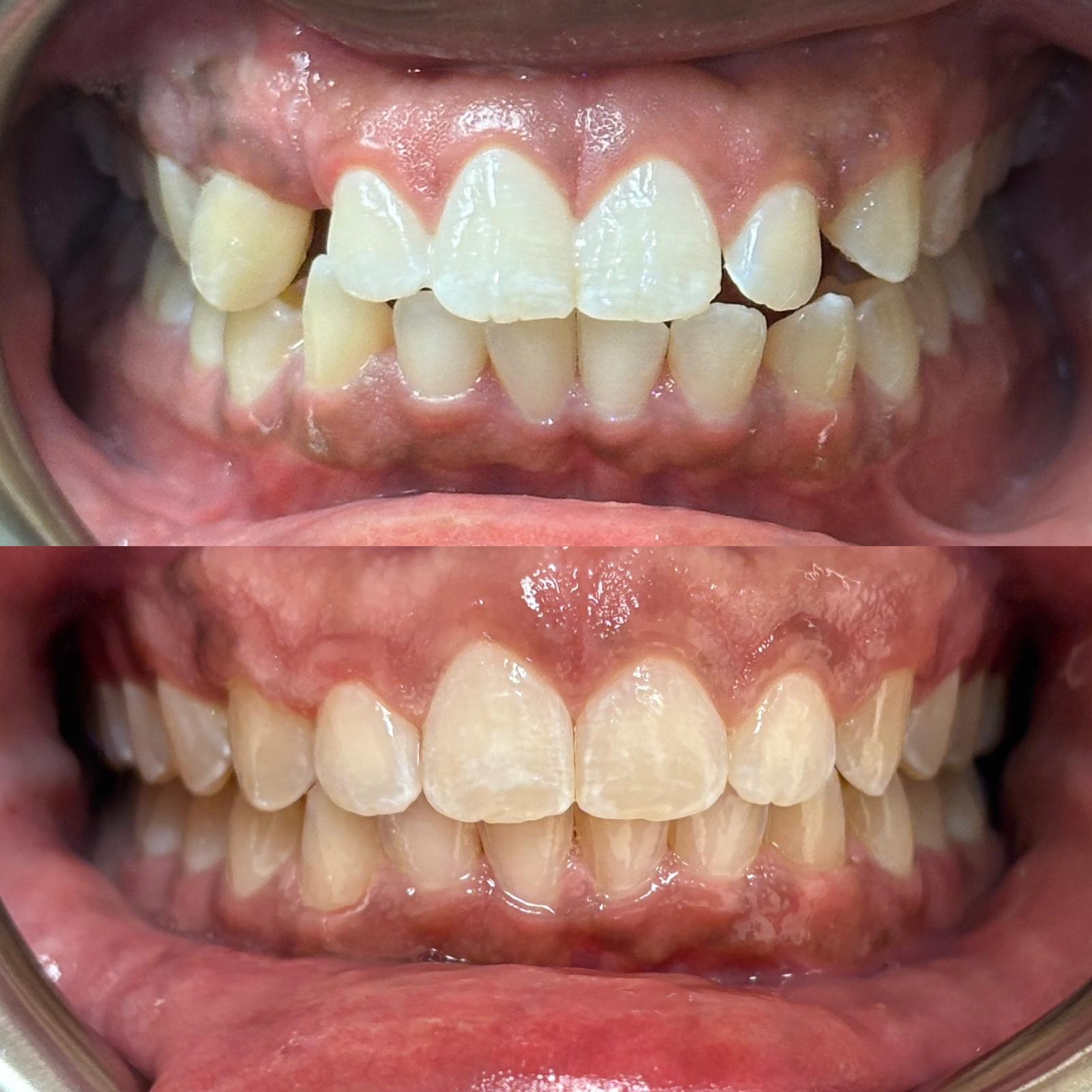 Invisalign before and after