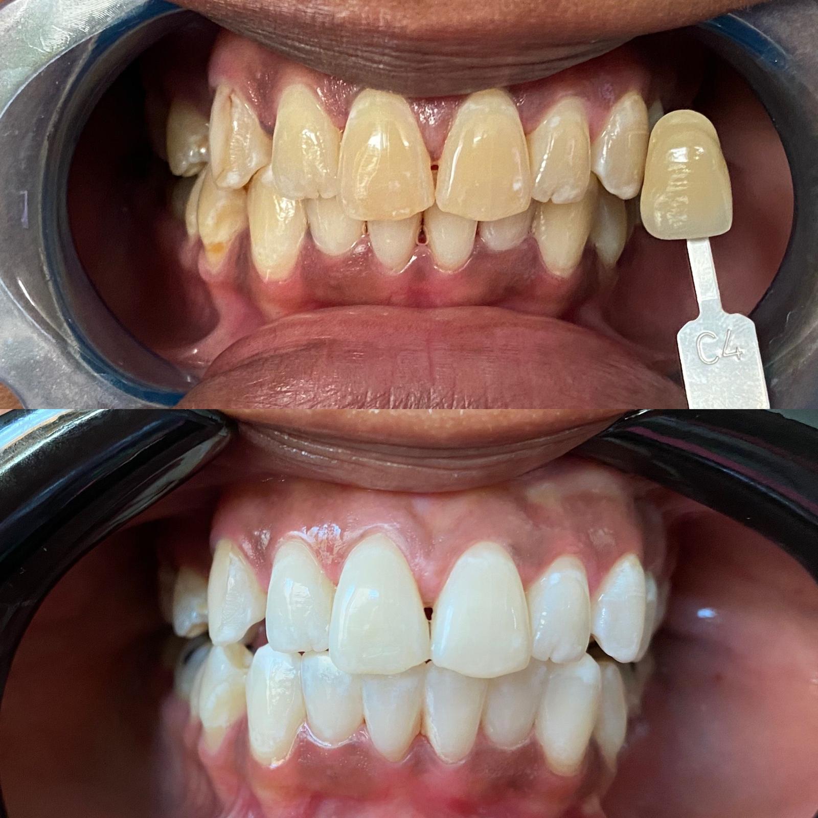 Teeth Whitening Before adn After Treatment