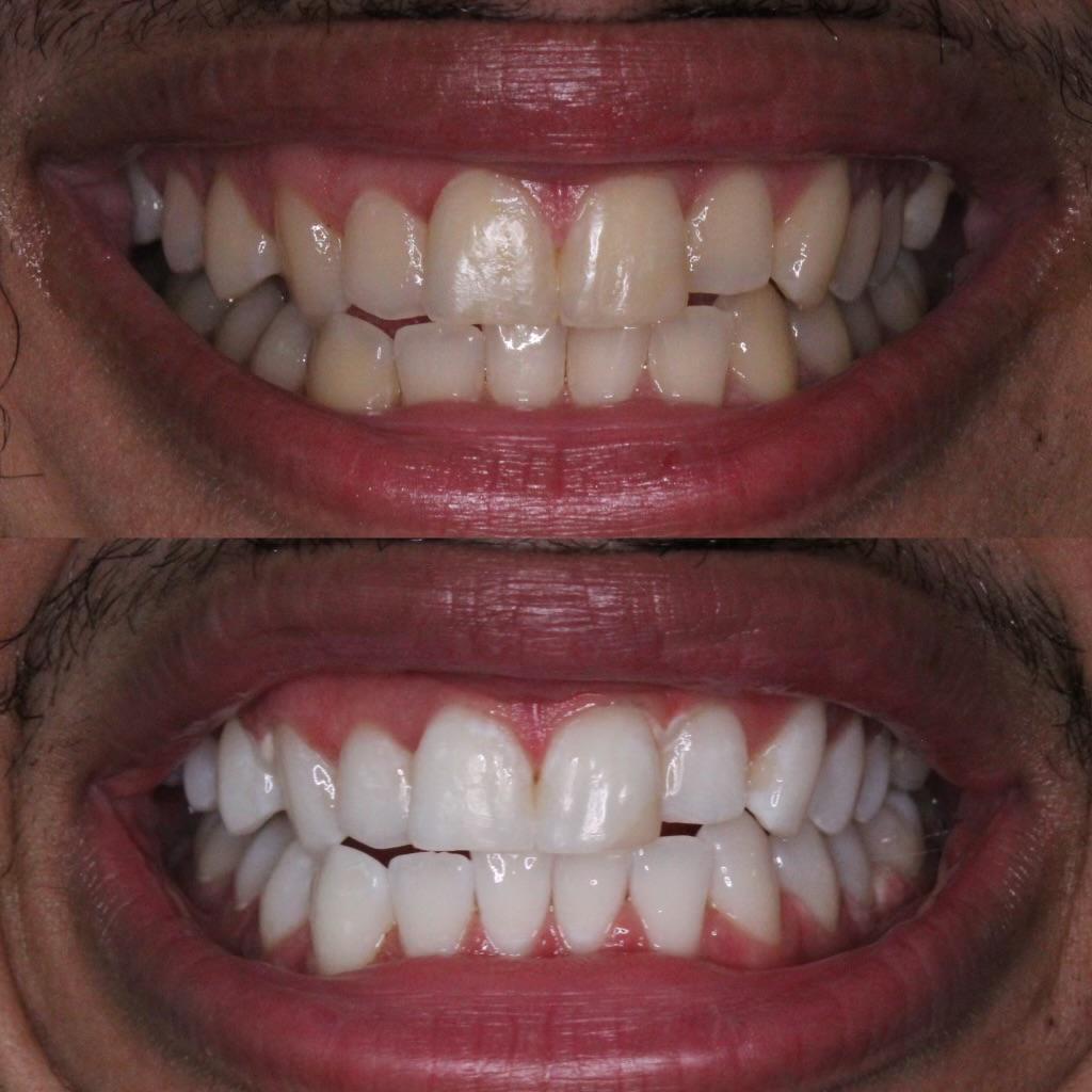 Teeth Whitening Before adn After