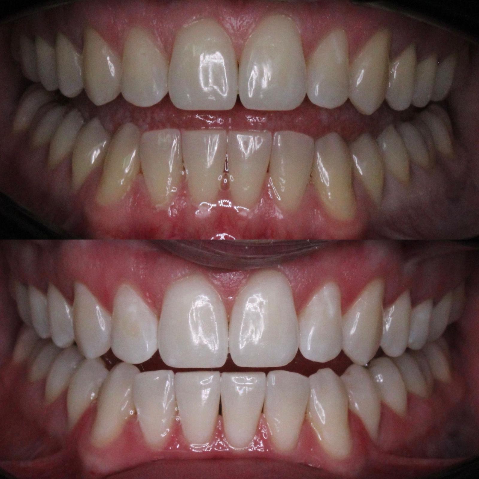 Teeth Whitening Before and After Treatment