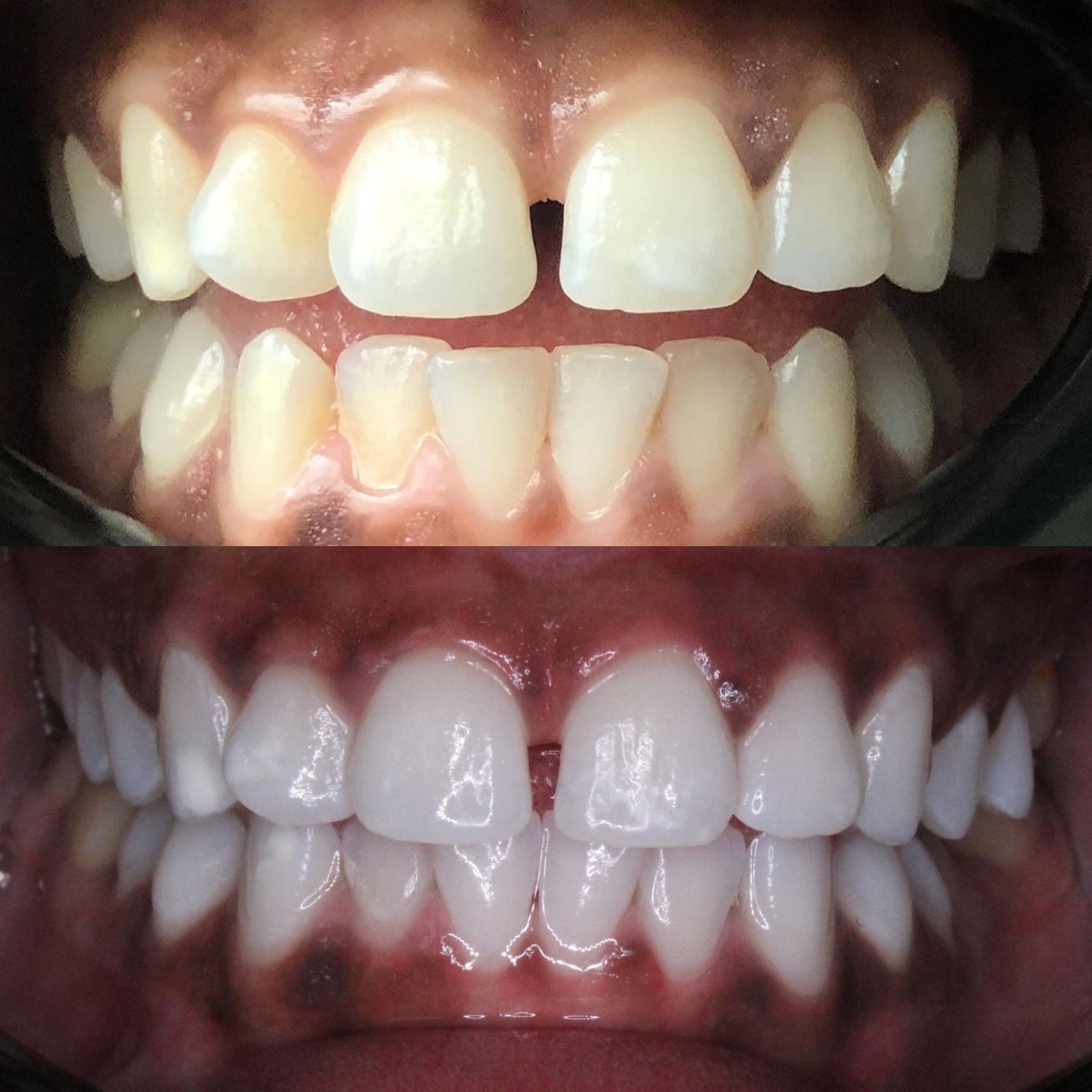 Teeth Whitening Before and After