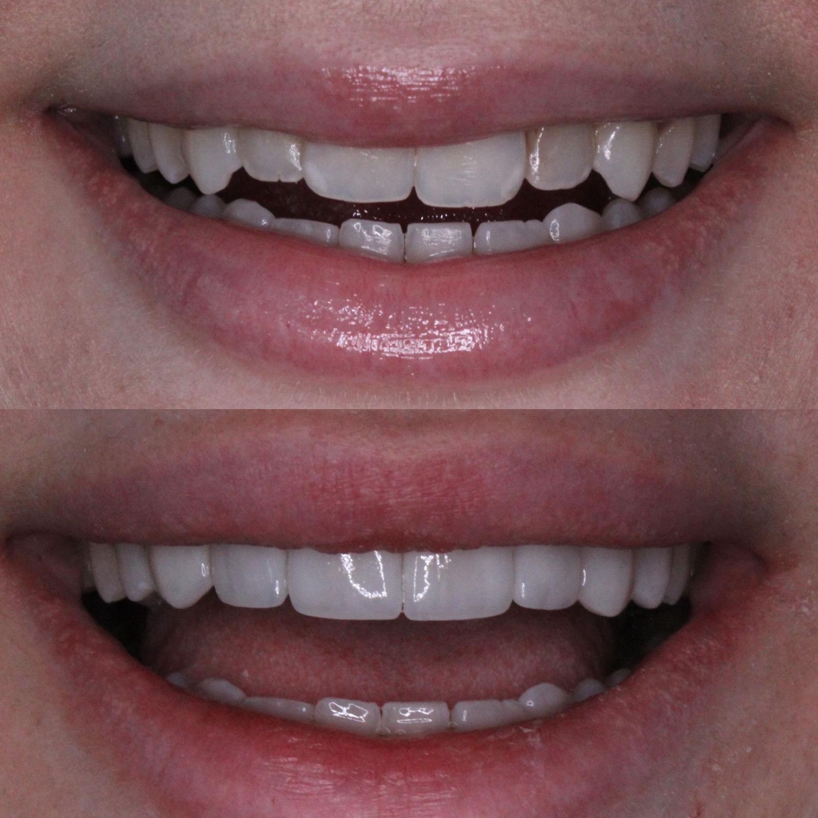 Veneers Before After Treatment