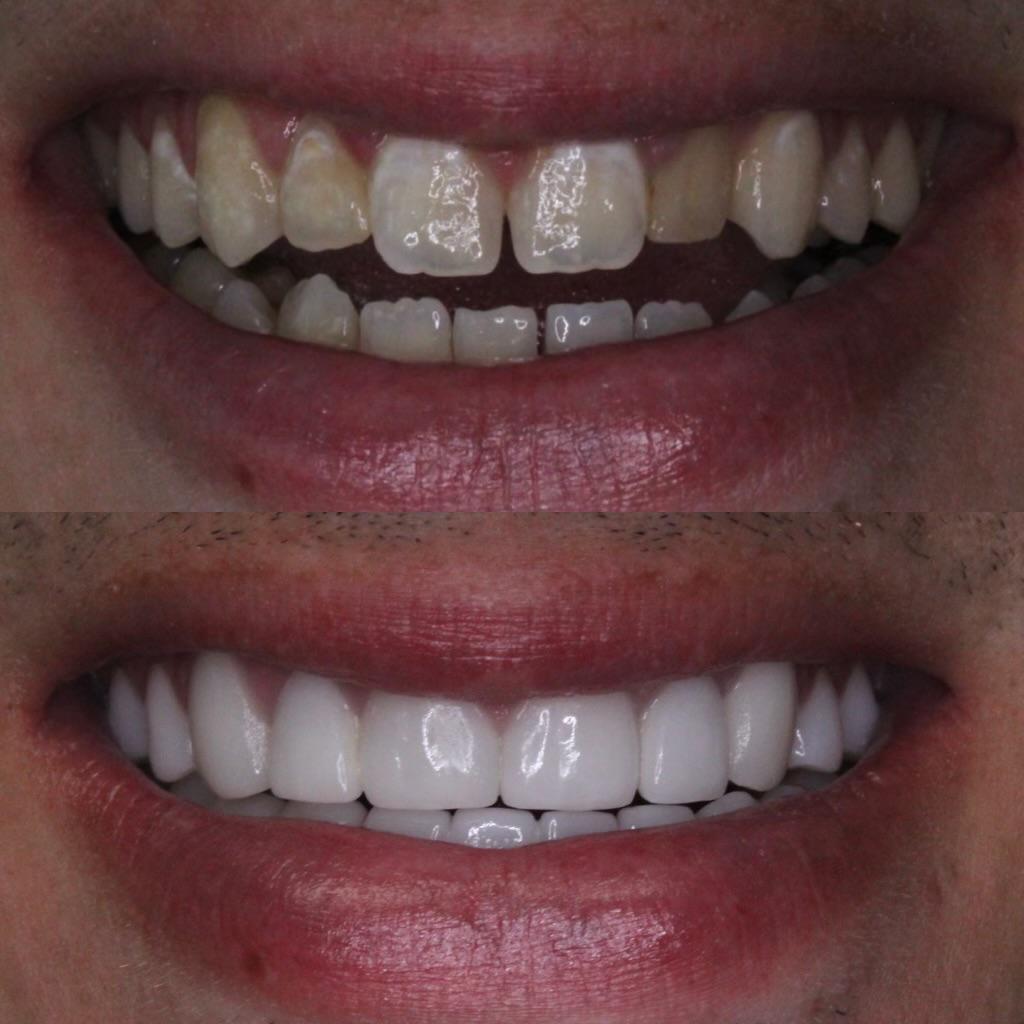 Veneers Before After Treatments