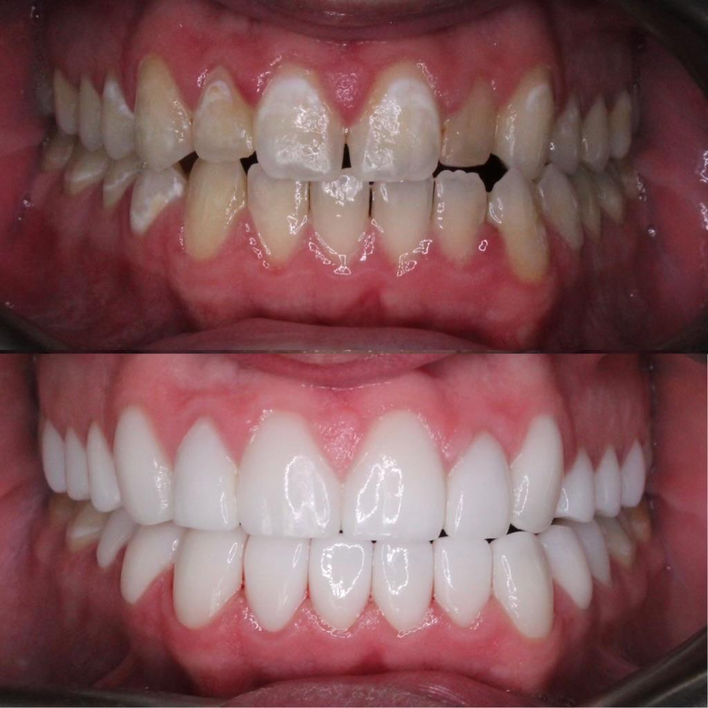Veneers Before and After