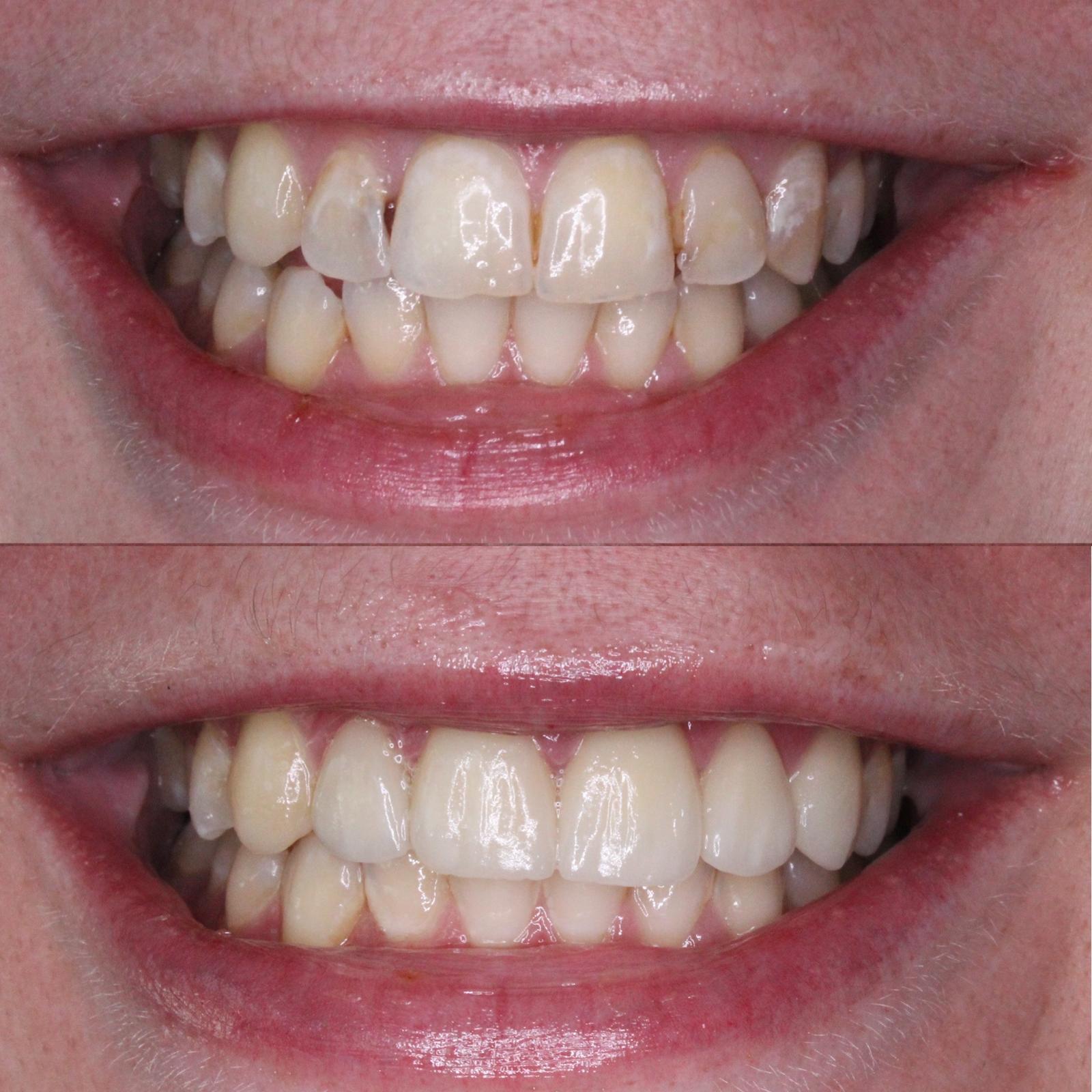 Veneers Treatment Before And After