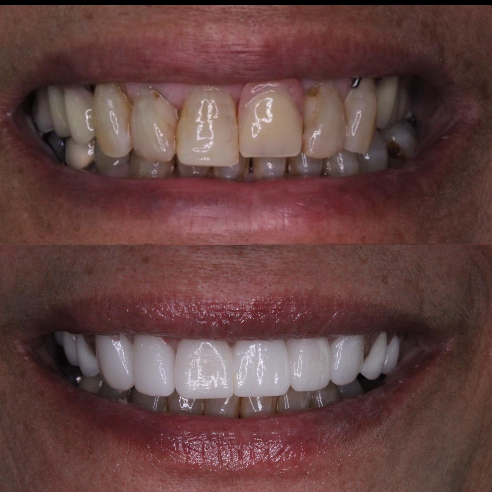Veneers and prosthodontics