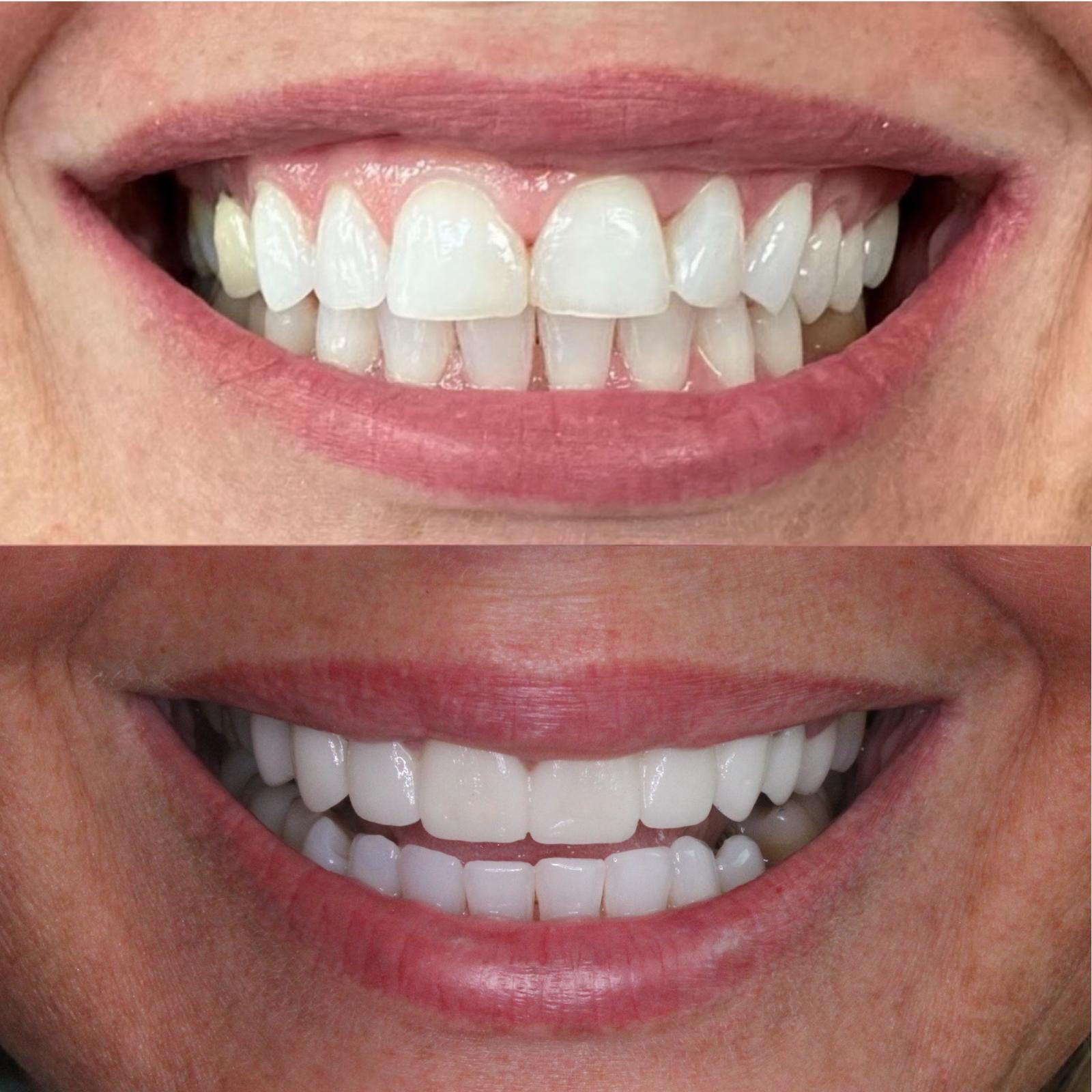 Veneers